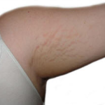 arm stretch marks