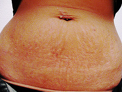 treating mid rift stretch marks