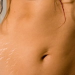 torso stretch marks