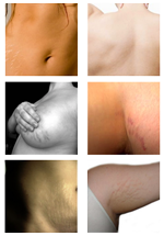 stretch mark pictures thumbnail