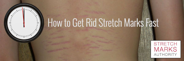 Remove Stretch Marks Fast