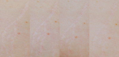 Photographic results of a 3rd party clinical study on Strianix.