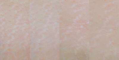 Reduction in the appearance of stretch marks during a clinical study on Strianix.