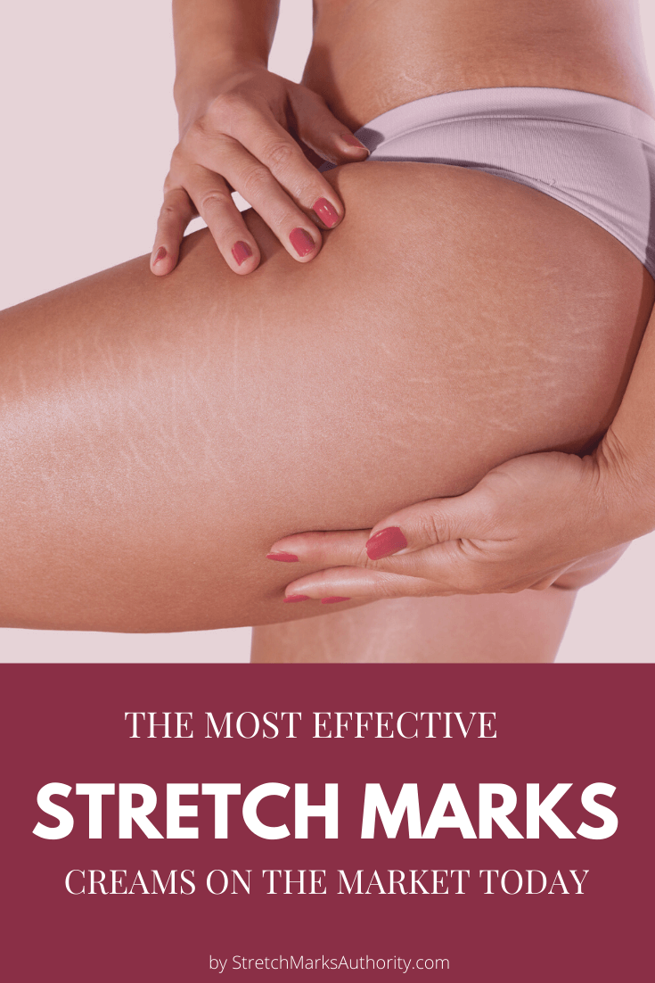 WHAT ARE THE MOST EFFECTIVE STRETCH MARK CREAMS ON THE MARKET TODAY