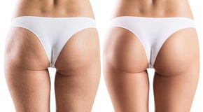 Female-Buttocks-Before-after